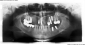 Implantati u obe vilice
